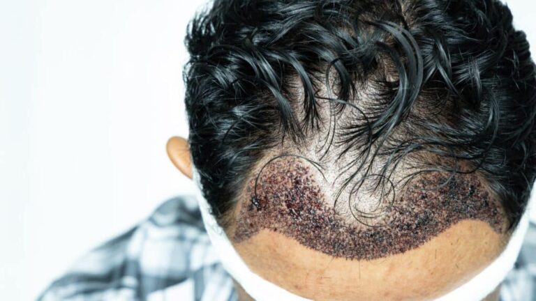 Hair Transplant